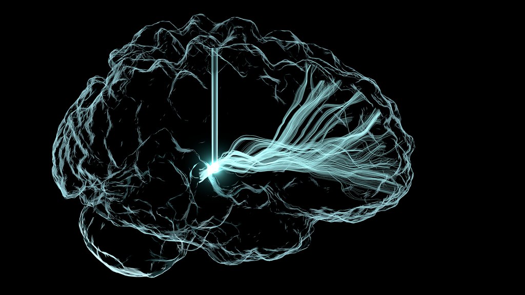 brain stimulation shows promise for parkinson's anxiety
