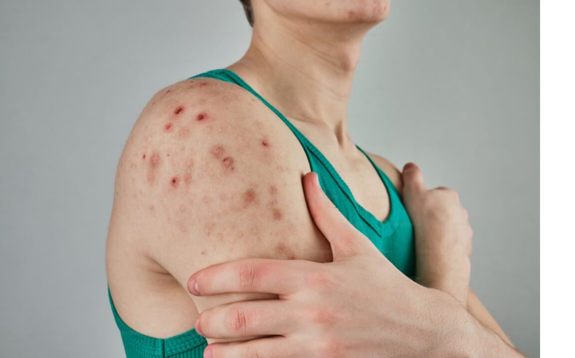 measlesphoto (1)